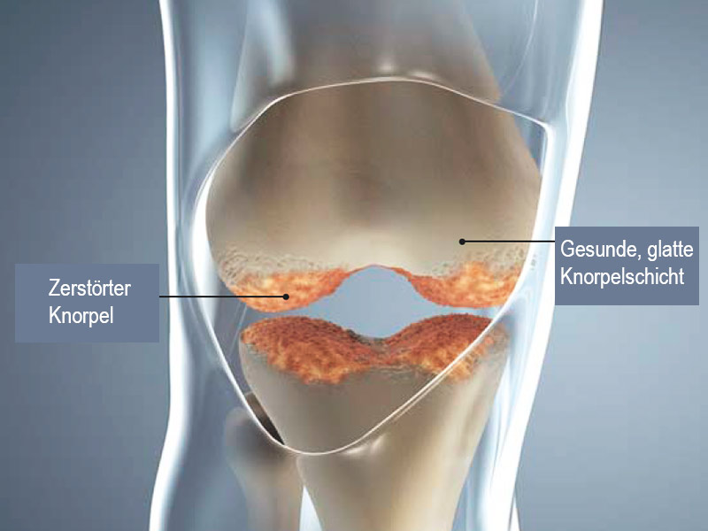 Knie Schmerzen Gelenk Arthrose