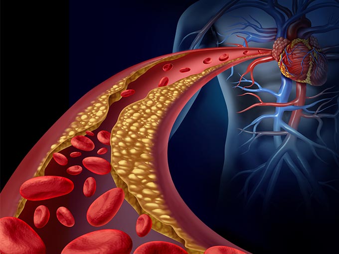 Cholesterin Cholesterinspiegel Gesundheit Herzkreislauf