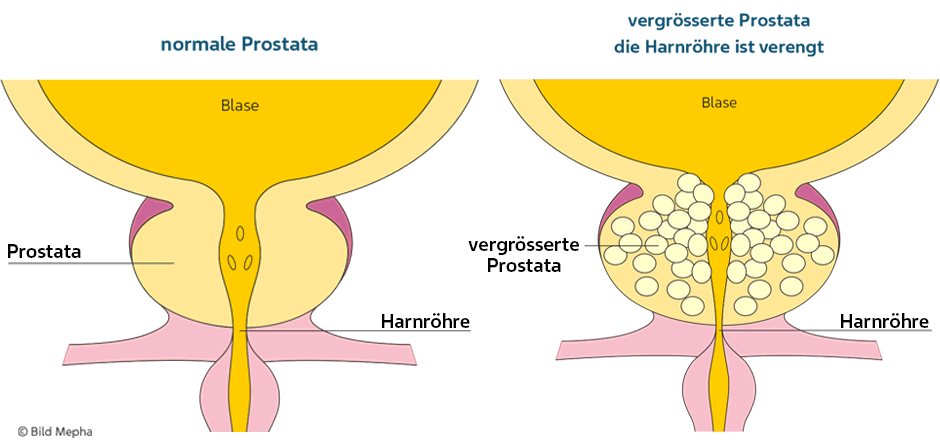 Harnröhre Prostata Verengung Darstellung Männergesundheit