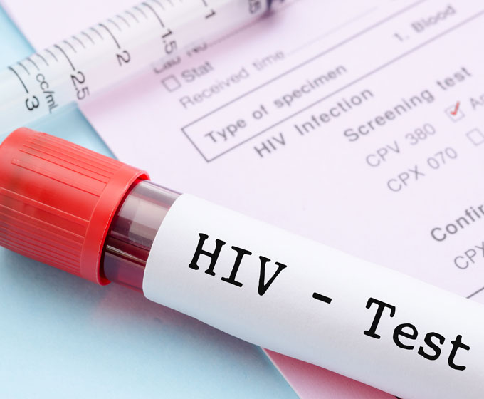 HIV Test Sexuelle Erkrankungen Männergesundheit