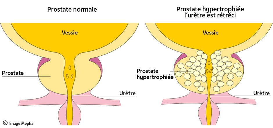 Prostate-hypertrophiee-uretre-retreci-940.png