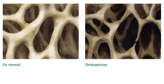 Vergleich Osteoporose Knochen 