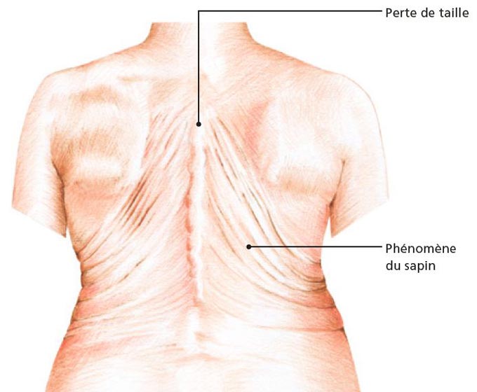 Tannenbaumphänomen Osteoporose Rücken Darstellung